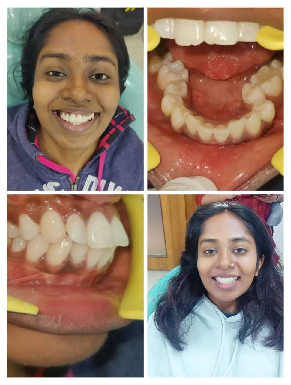 Anterior Smile Correction #3